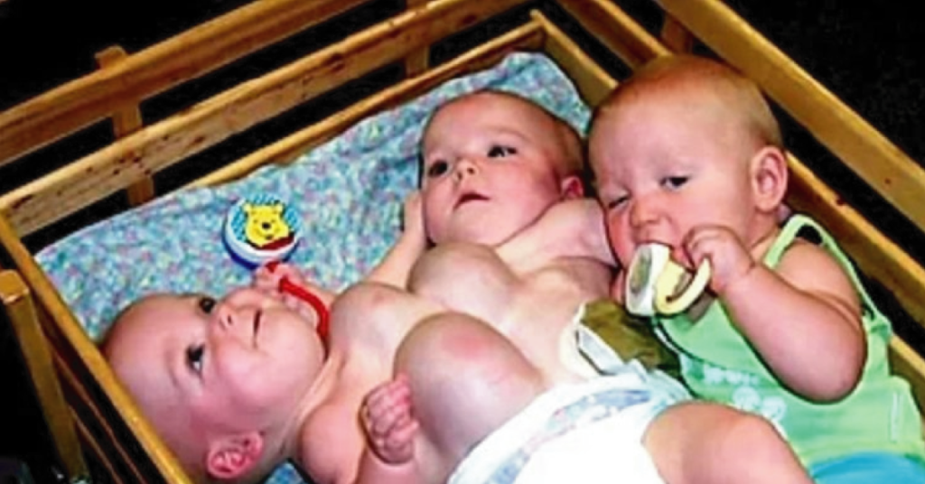 Once conjoined triplets, now 17 years olds