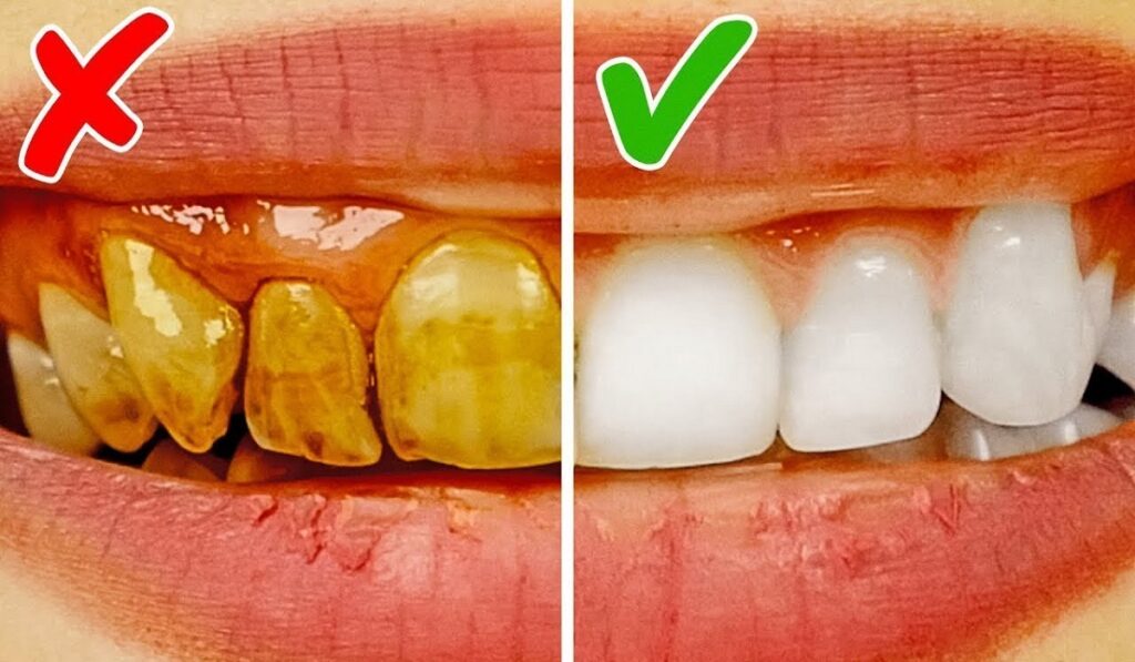 Sarı dişleriniz 2 dakikada bembeyaz olsun